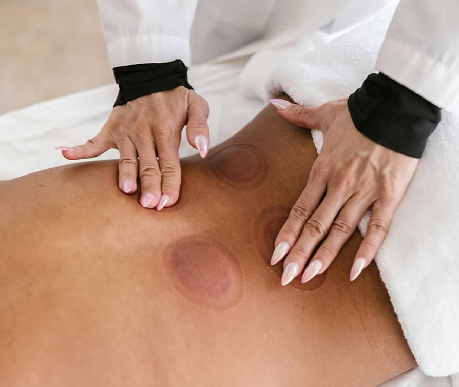 Glasgow Premier Physiotherapy Cupping Therapy