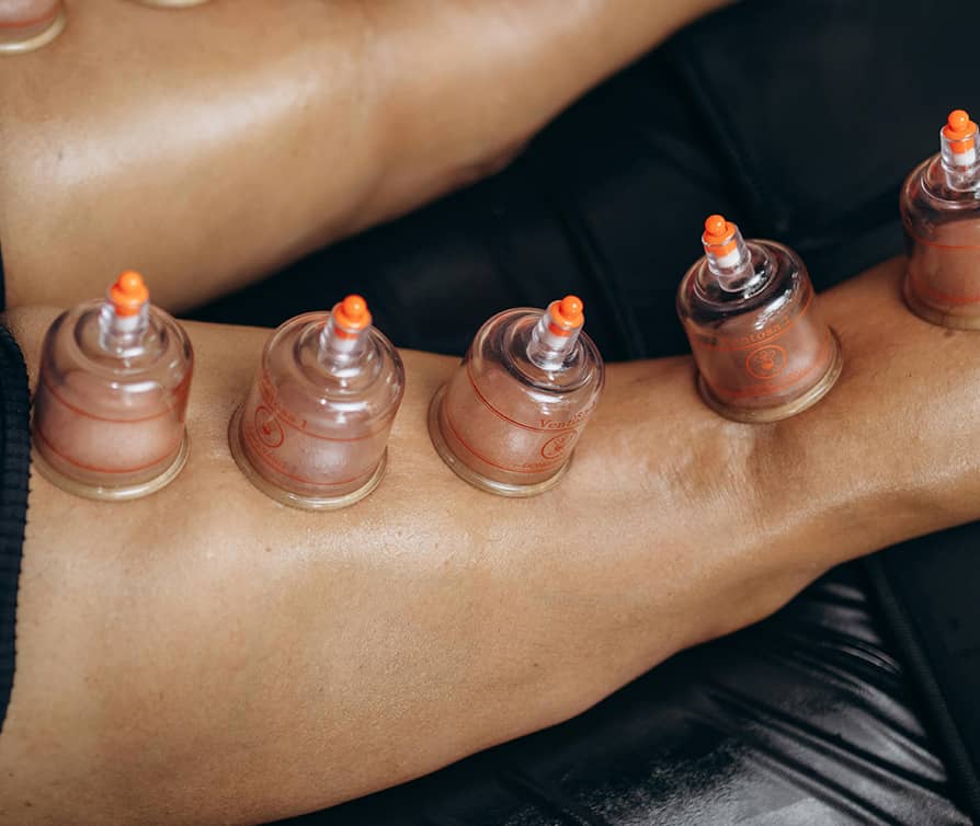Glasgow Premier Physiotherapy Cupping Therapy
