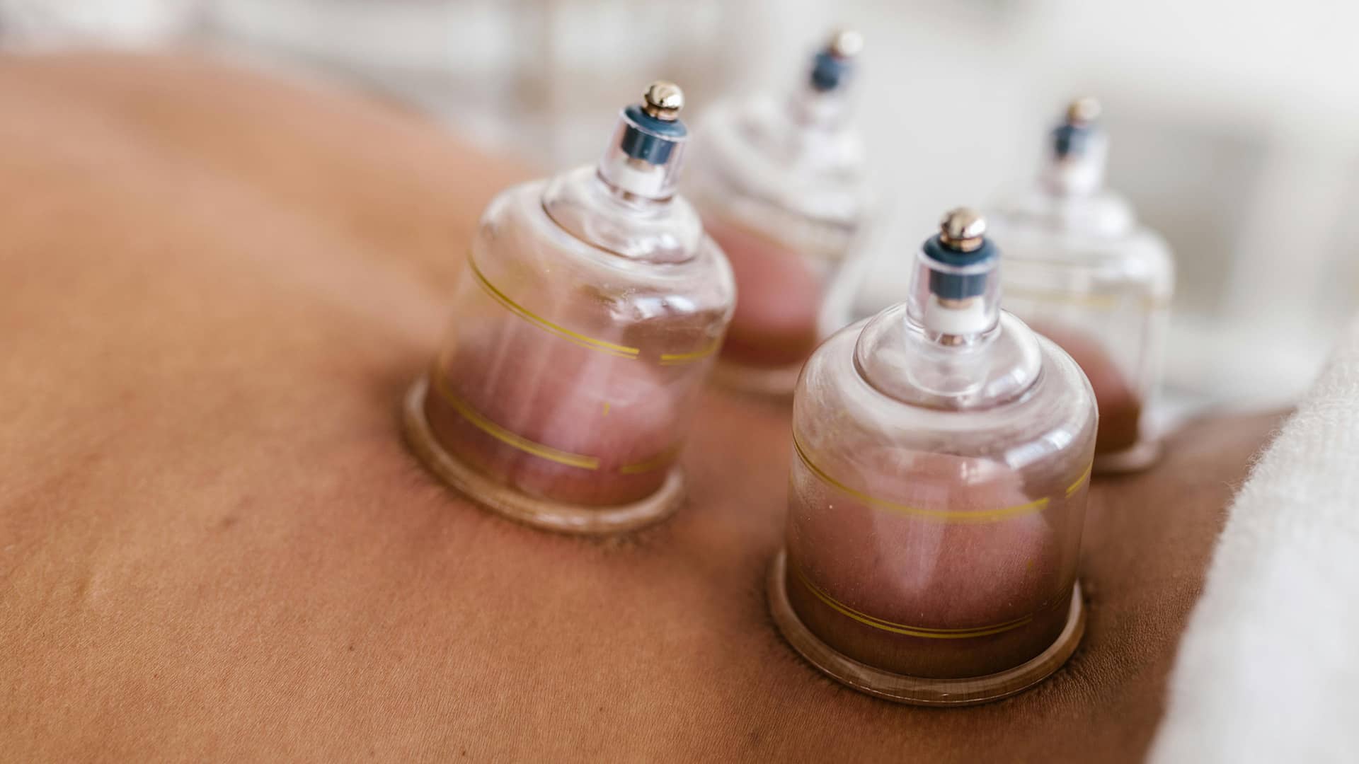 What is Cupping Therapy and What Are The Benefits
